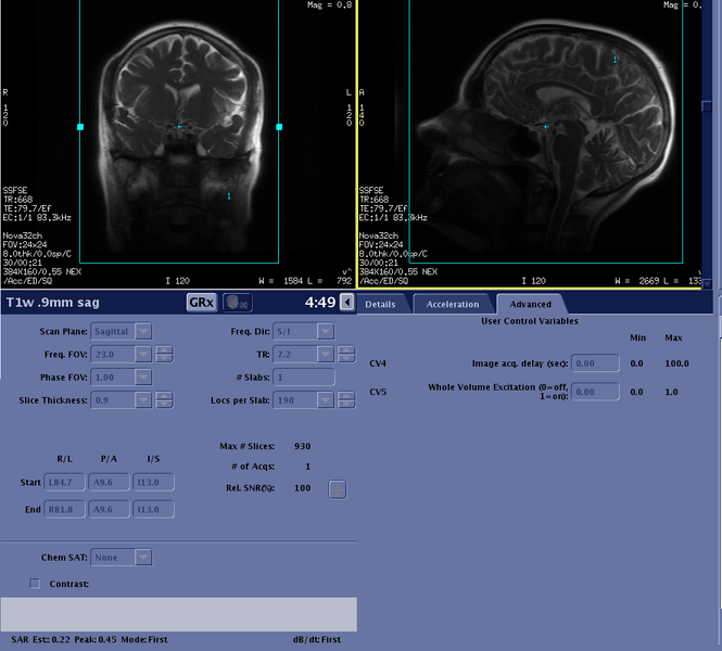 File:T1w 09mm sag adv.png