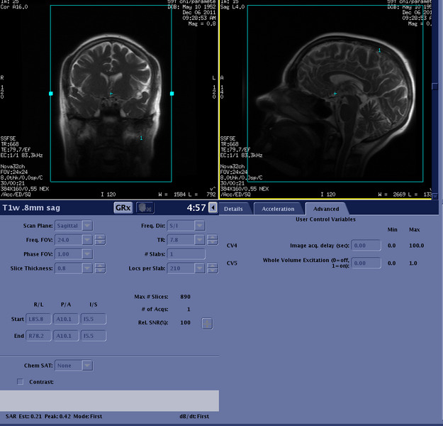 File:T1w 08mm sag adv.png