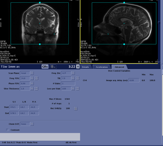 File:T1w 1mm ax adv.png
